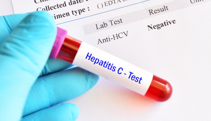 UK NHS England set to eliminate hepatitis C by 2030 as the first in the ...